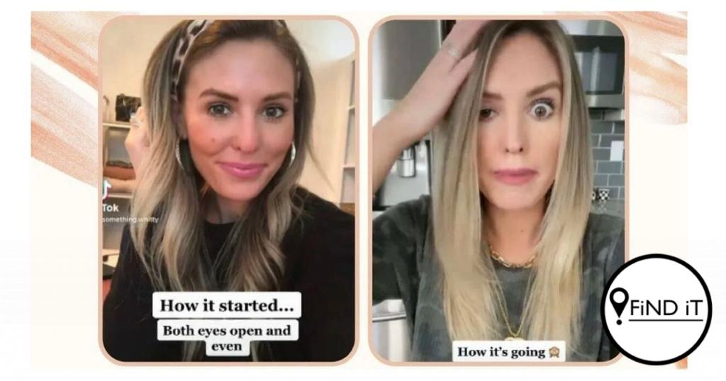 Botox-nagmerrie - dit kos net een inspuiting in die verkeerde plek