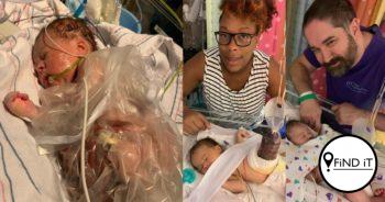 The Inside-out baby needed a life-saving quadruple organ transplant.