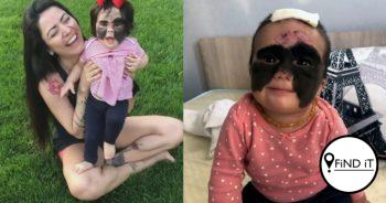 The 'batman girl' who was born with a birthmark like mask on her face has been forced to stop treatment to have it removed shortly before the last operation in Russia – because her visa ran out.