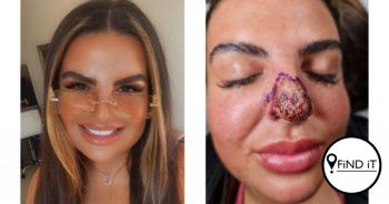 The 26-year-old's claims her nose turned white and ice-cold as the flesh was dying and rotting away.