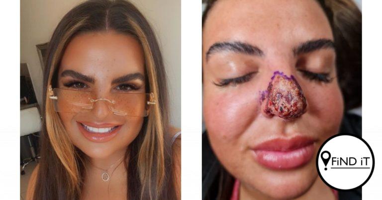 The 26-year-old's claims her nose turned white and ice-cold as the flesh was dying and rotting away.