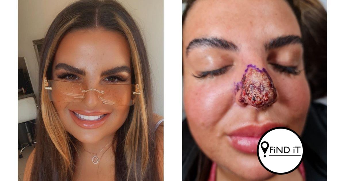 The 26-year-old's claims her nose turned white and ice-cold as the flesh was dying and rotting away.