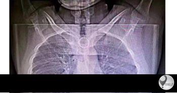 The sharp, wavy object ended up in the student’s oesophagus and was at risk of causing internal damage or haemorrhaging.