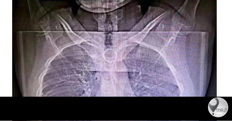 The sharp, wavy object ended up in the student’s oesophagus and was at risk of causing internal damage or haemorrhaging.