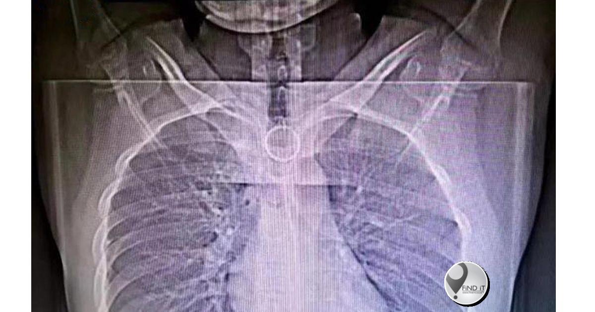 The sharp, wavy object ended up in the student’s oesophagus and was at risk of causing internal damage or haemorrhaging.