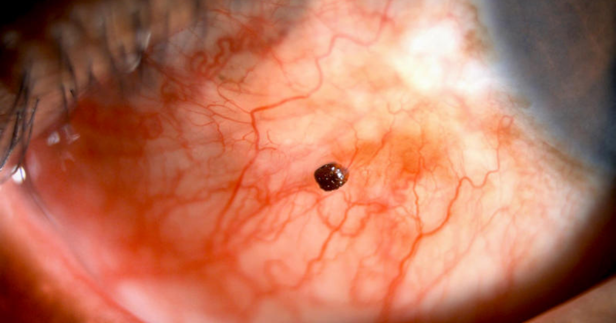 Head of ant that bit man on the eye remains wedged in his eyeball