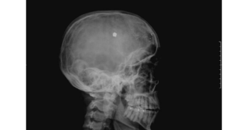 Gunshot victim spent a decade with bullet lodged in his brain now lives a normal life