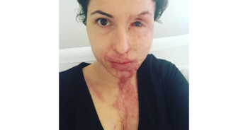 Acid attack victim dissolves charity she founded to help burn victims