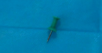 Boy has drawing pin removed from windpipe after swallowing it
