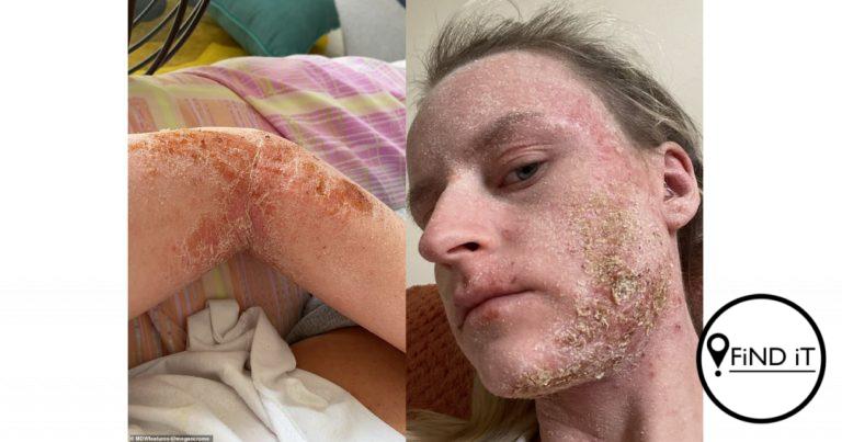 Vrou op 6 jaar gediagnoseer met erge ekseem, waarsku mense teen steroïedroom
