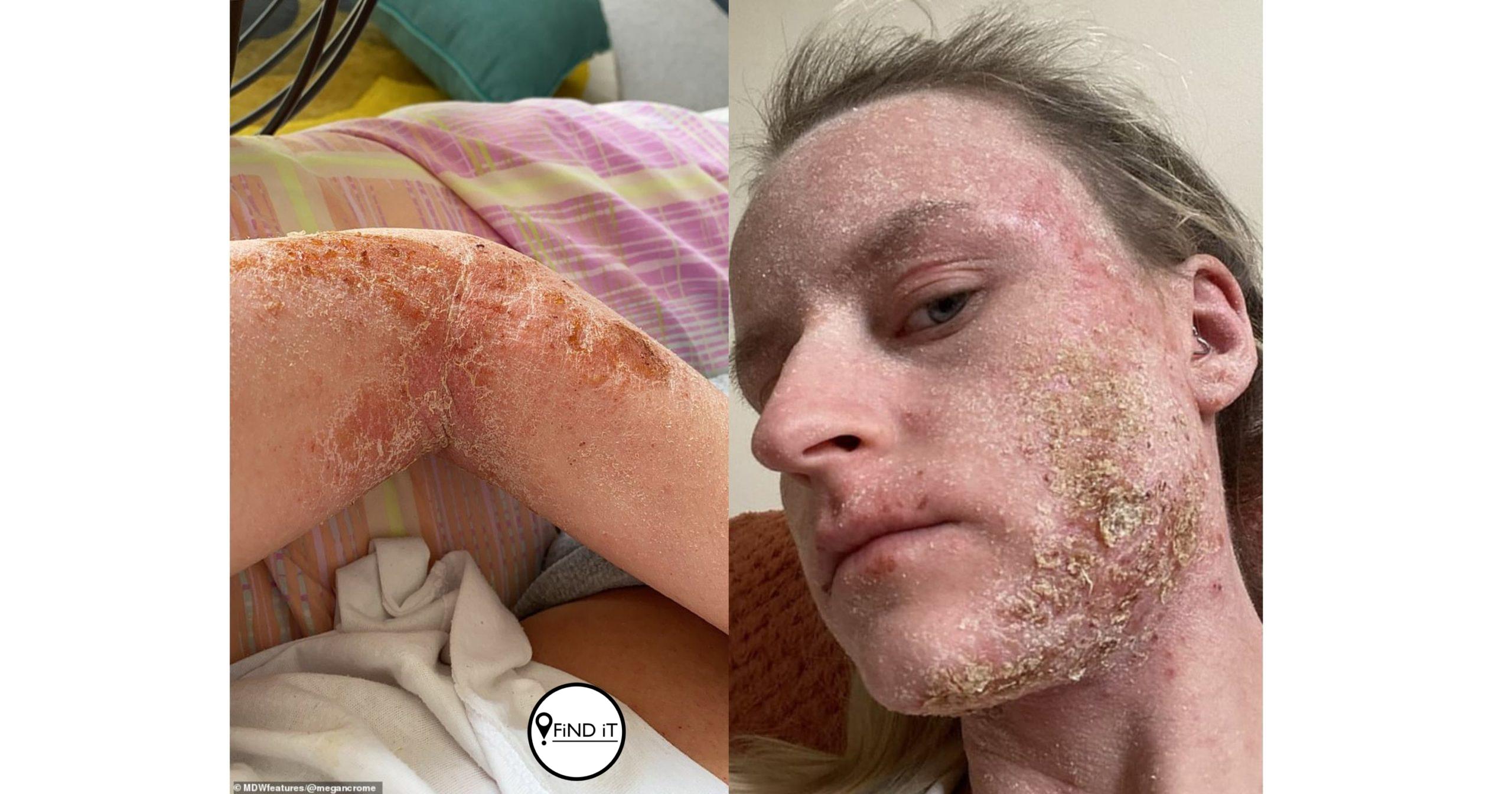 Vrou op 6 jaar gediagnoseer met erge ekseem, waarsku mense teen steroïedroom