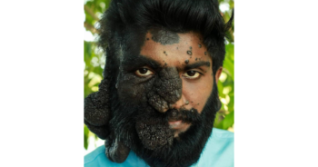 THIS MAN was born with moles covering EIGHTY PER CENT of his face