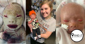 This girl was born with an extremely rare genetic skin disease.
