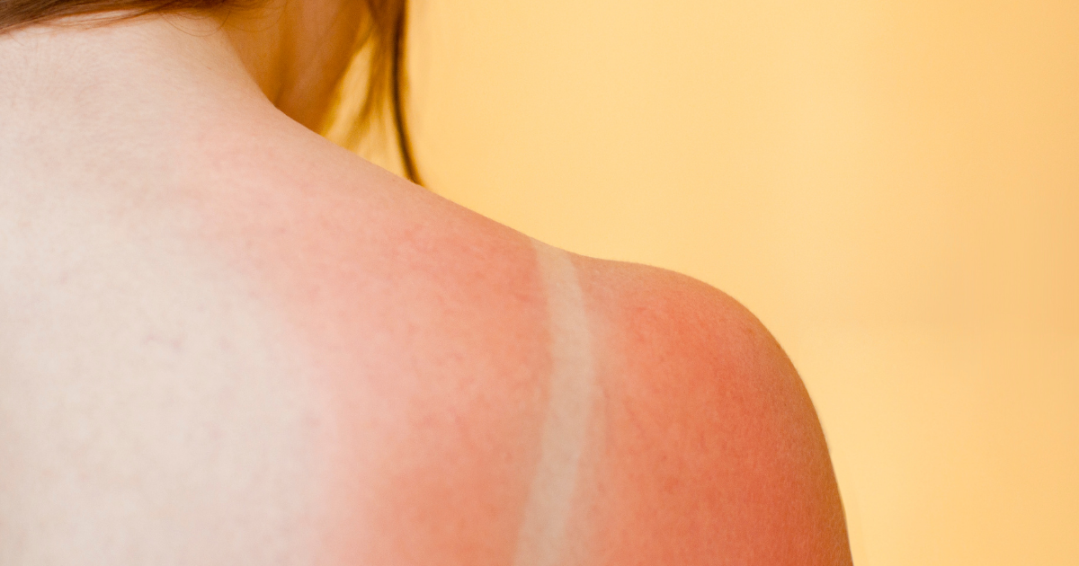 Burnt - baby - sunburnt