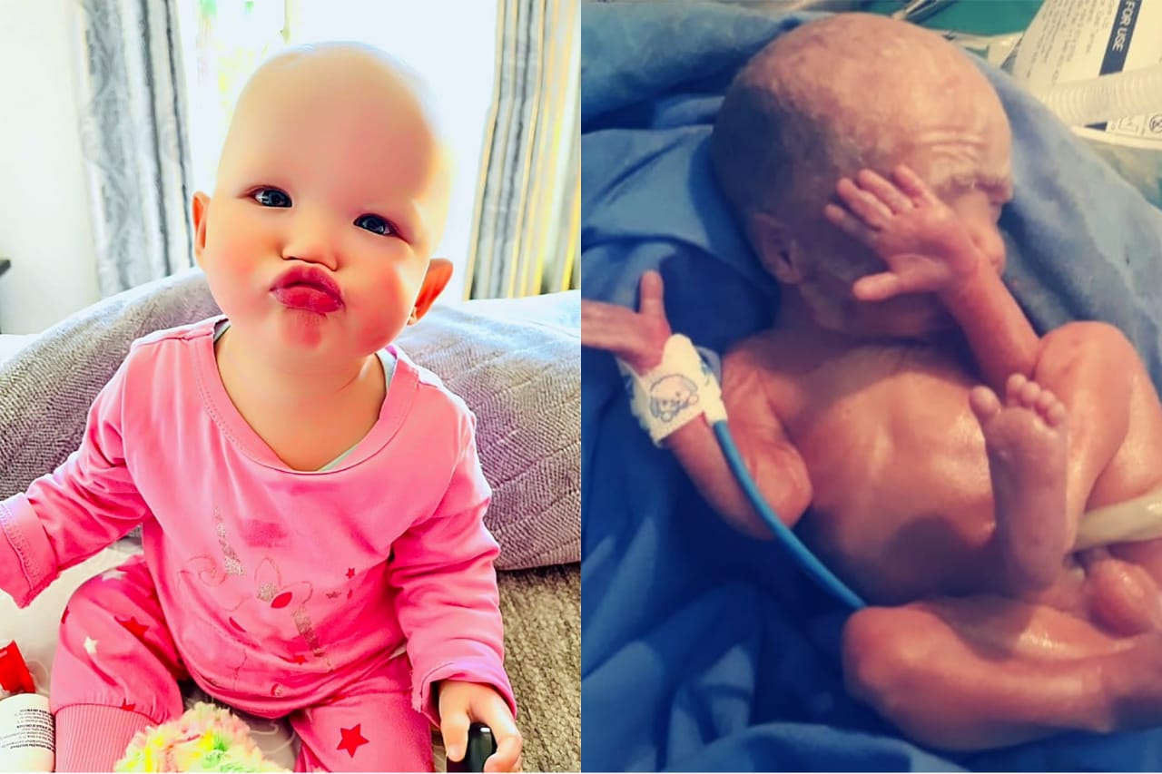 'Déjà vu-oomblik' toe tweede baba in NICU opgeneem word