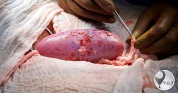 Pig kidney transplanted in human successfully