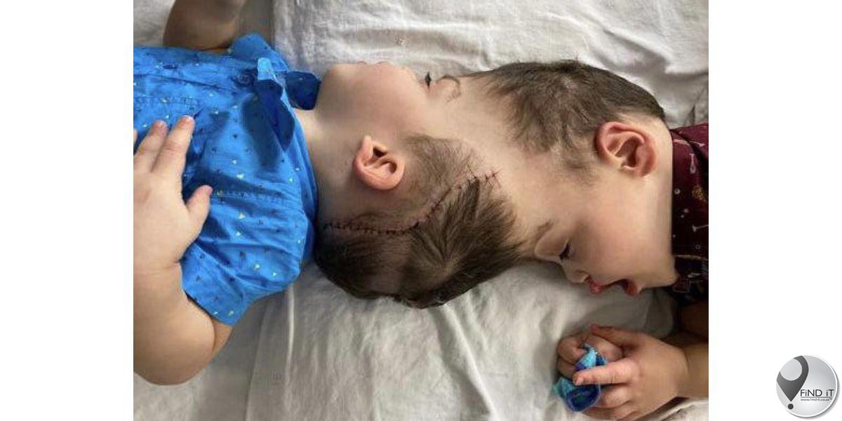 Verbonde tweeling met saamgesmelte brein suksesvol geskei in Brasilië